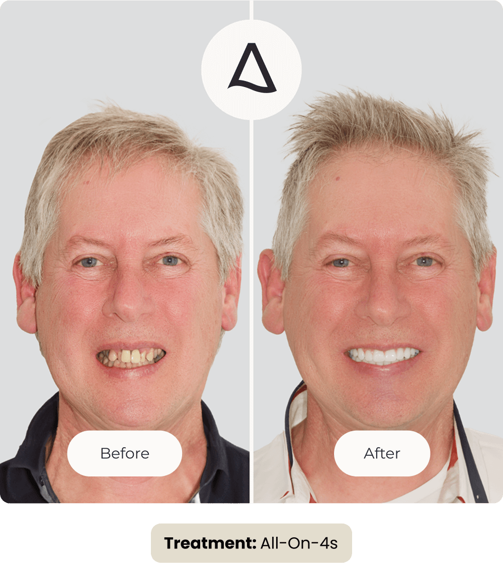 PDS_Implants LP_Gary Image_2x